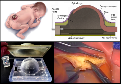 Montage of diagrams and photos of Surgical Simulator for Spina Bifida Repair
