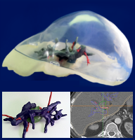 3D printed model assembly of liver with tumor and blood vessels.