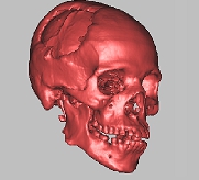 Digital 3D model of skull with trauma injury.