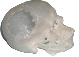 Physical Biomodel of skull with trauma injury.
