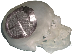 Biomodel of model of injured skull with custom-fit cranial plate.