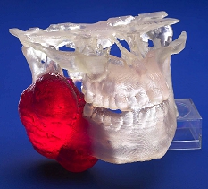 Biomodel of full jaw with tumor.