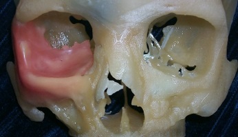 Image showing Biomodel used to produce patient-specific orbital implant.