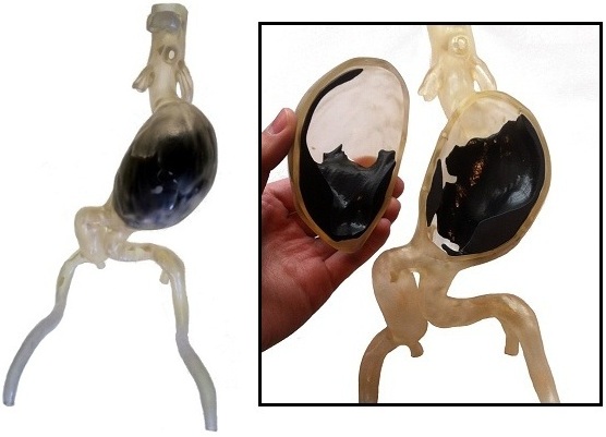 Image showing multiple-material Biomodel assembly of aortic aneurysm, showing clot & calcifications.