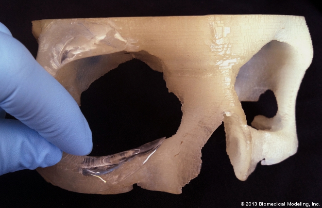 Template for patient-specific orbital implant.