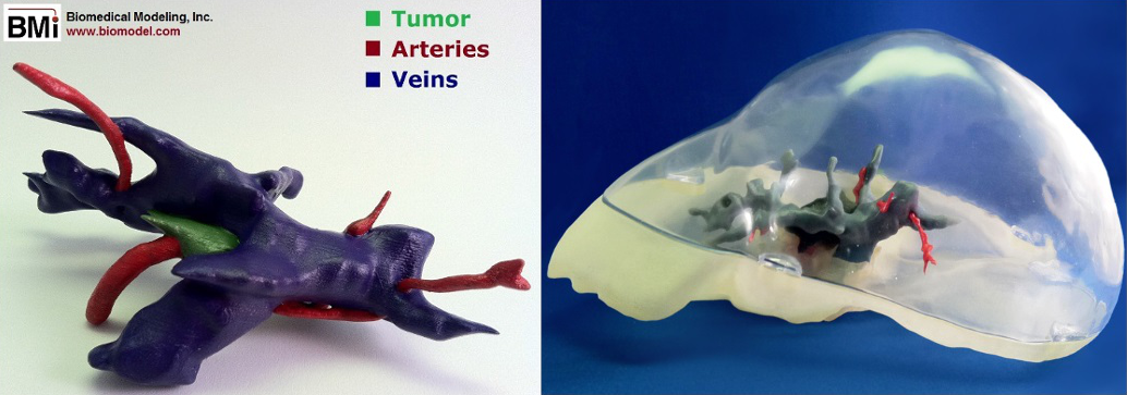 Biomodel assembly of liver with tumor and vasculature.